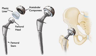 Hip Joint Replacement Ahmedabad